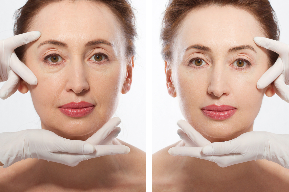 Before and after comparison of a woman's face showing the effects of dermal fillers for anti-aging.