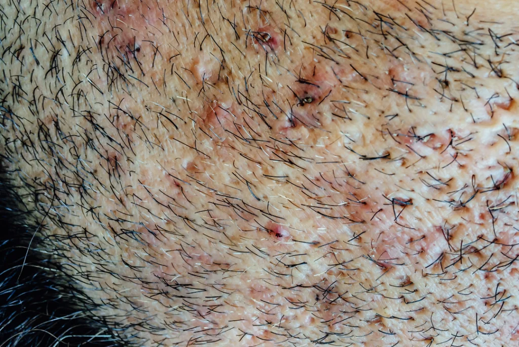 Close-up image of pseudofolliculitis barbae symptoms on the beard area requiring pseudofolliculitis barbae treatments.