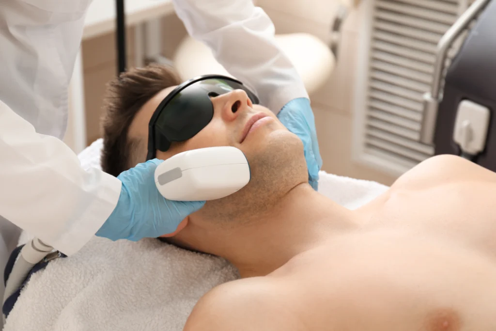  A man receiving professional laser therapy as part of pseudofolliculitis barbae treatments.