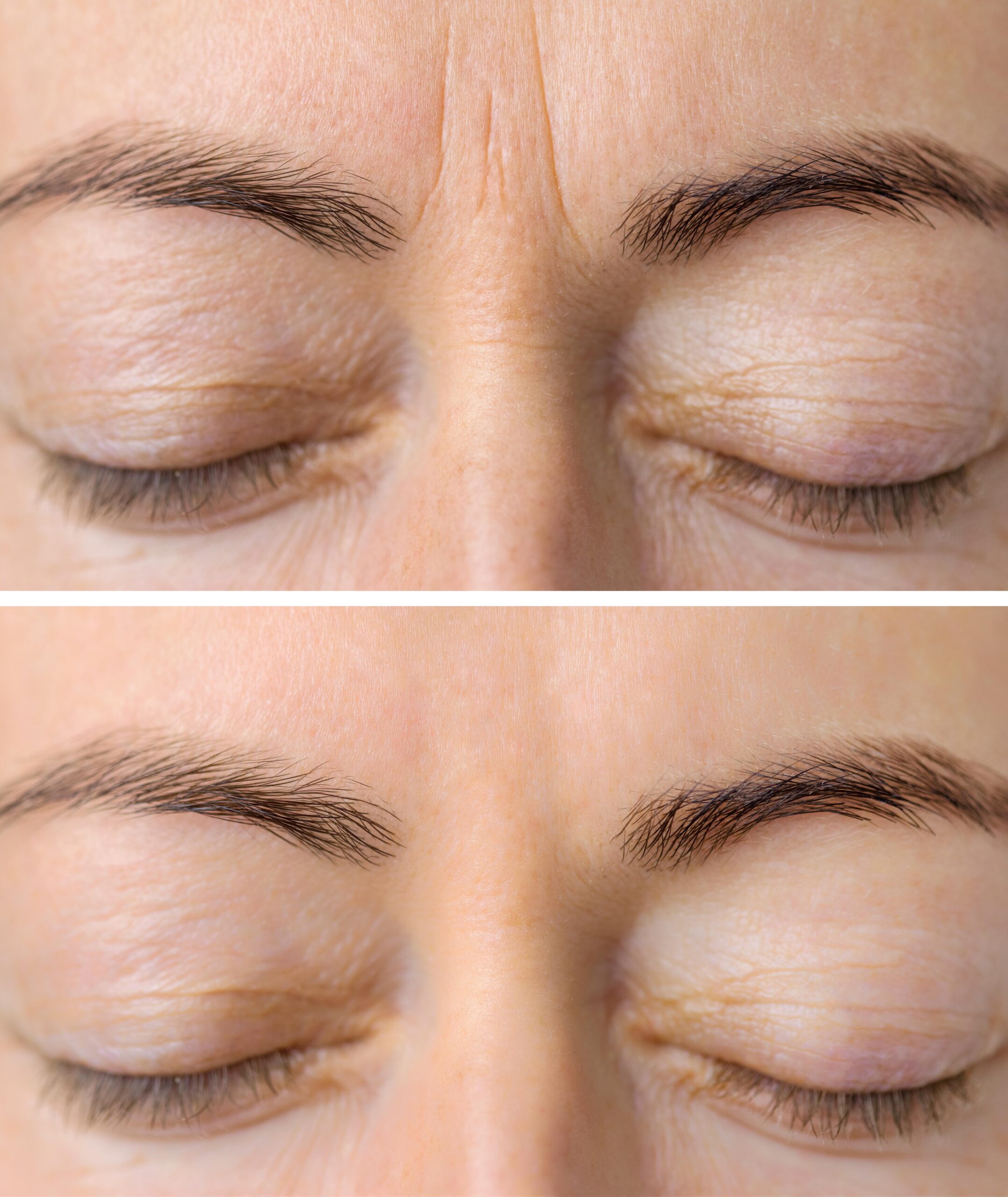 A before-and-after comparison of forehead wrinkles treated with Botox.