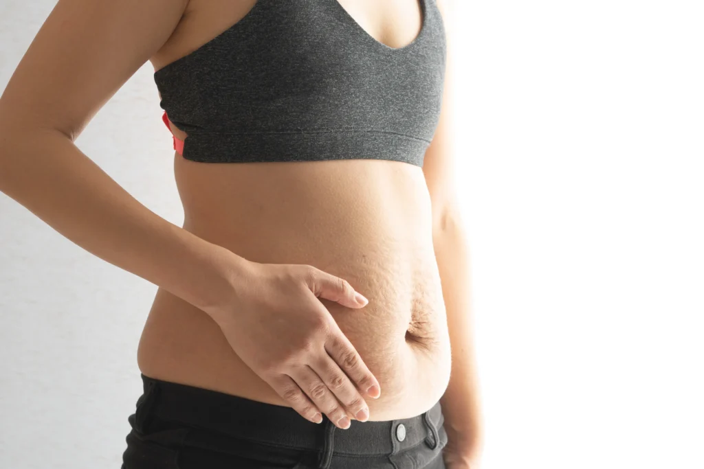 Person touching loose abdominal skin while standing in athletic clothing