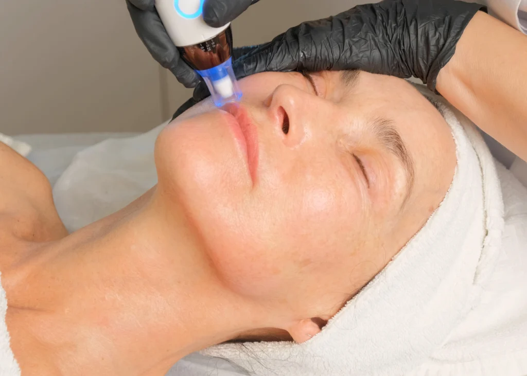morpheus8-microneedling-treatment-device-closeup