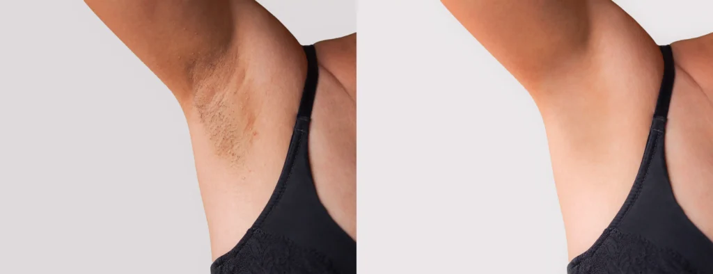 Left and right images compare an underarm before and after hair removal with visible hair reduced on the right.