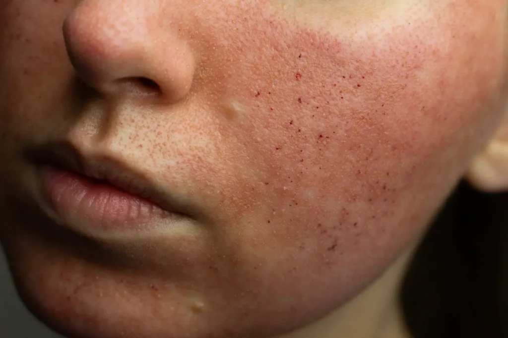 Close-up of a cheek showing visible redness, small dark spots, and textured skin.