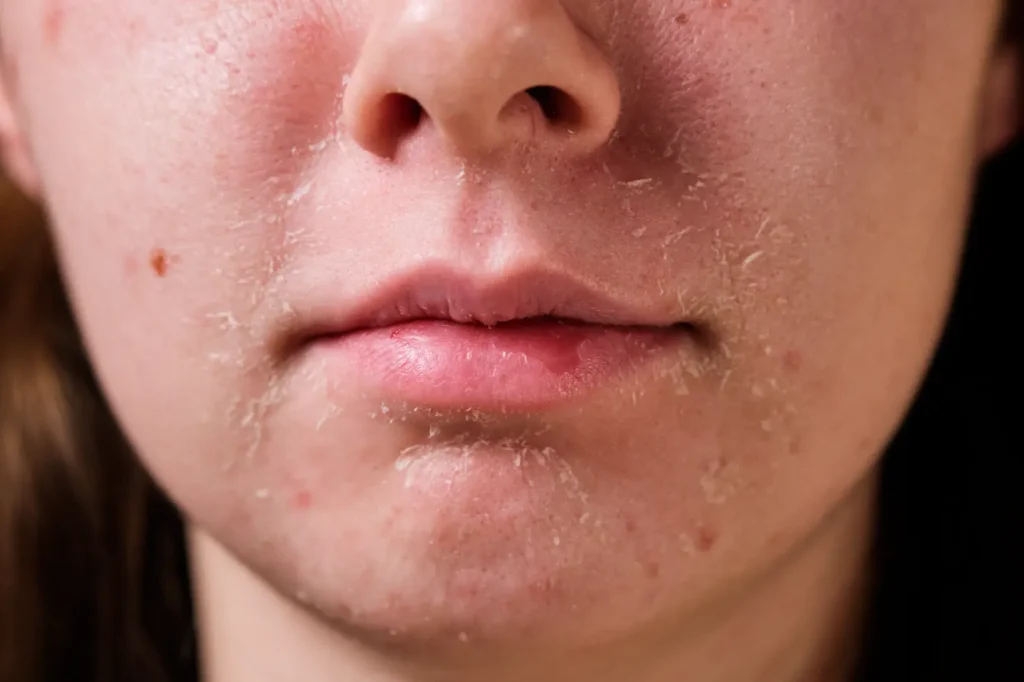 Close-up of a face with visible dryness, flaking and small blemishes around the cheeks, mouth and chin.