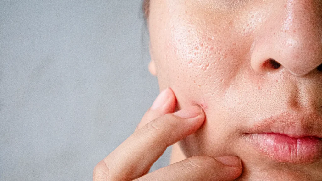 Close-up of a person pressing their cheek where enlarged pores and uneven skin texture are visible.