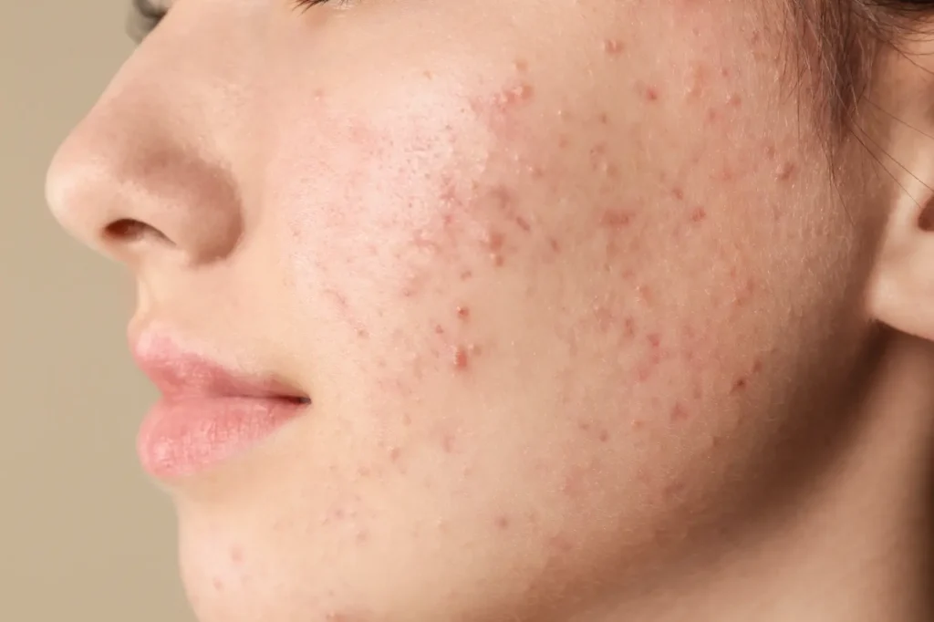 Close-up side view of a face with multiple small red bumps and uneven texture across the cheek.
