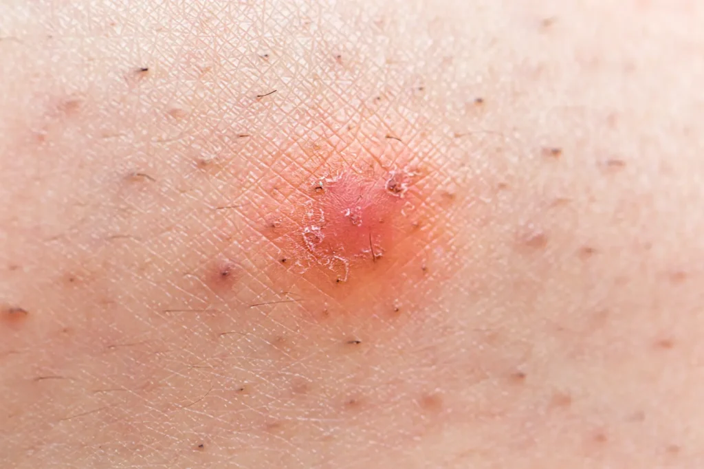 Close-up of a red raised bump surrounded by short hairs and visible hair follicles.