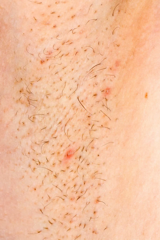 up of body hair with several curled hairs and small red bumps visible on the skin.