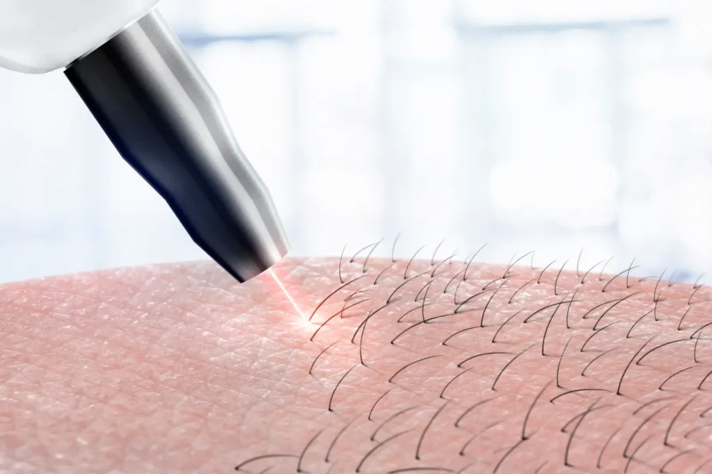 Laser device directs a beam toward skin with visible hair.