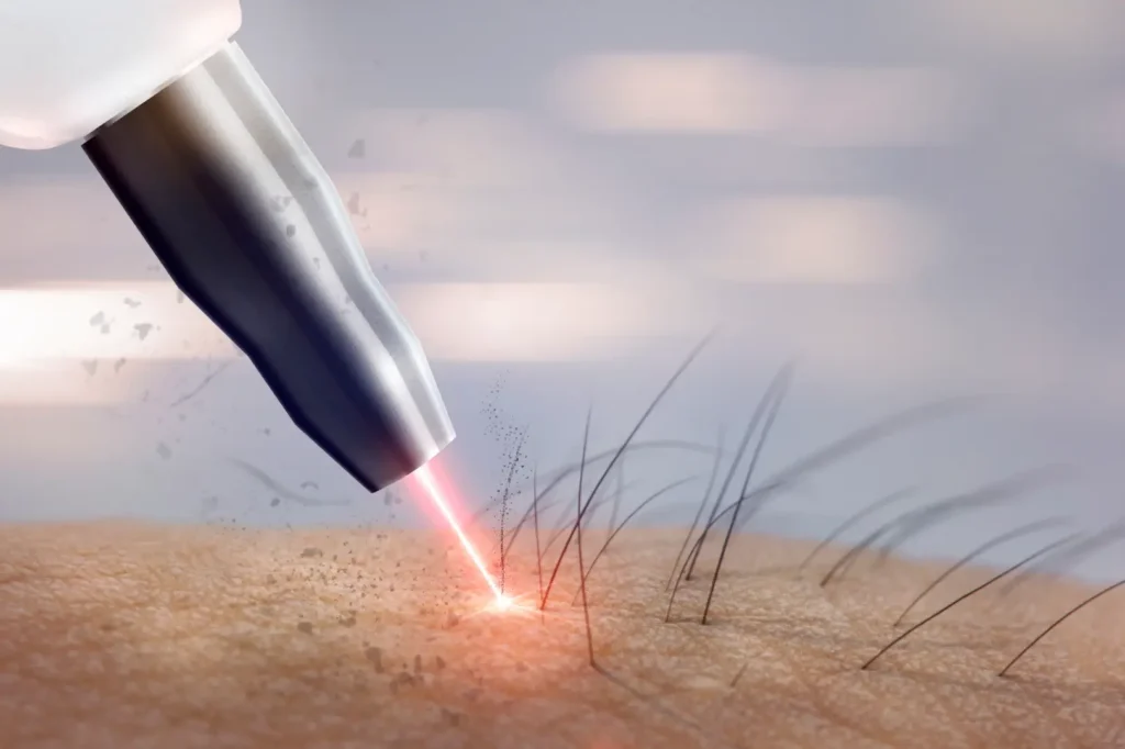 Close-up illustration of a handheld laser device directing a beam toward hair growing from skin.