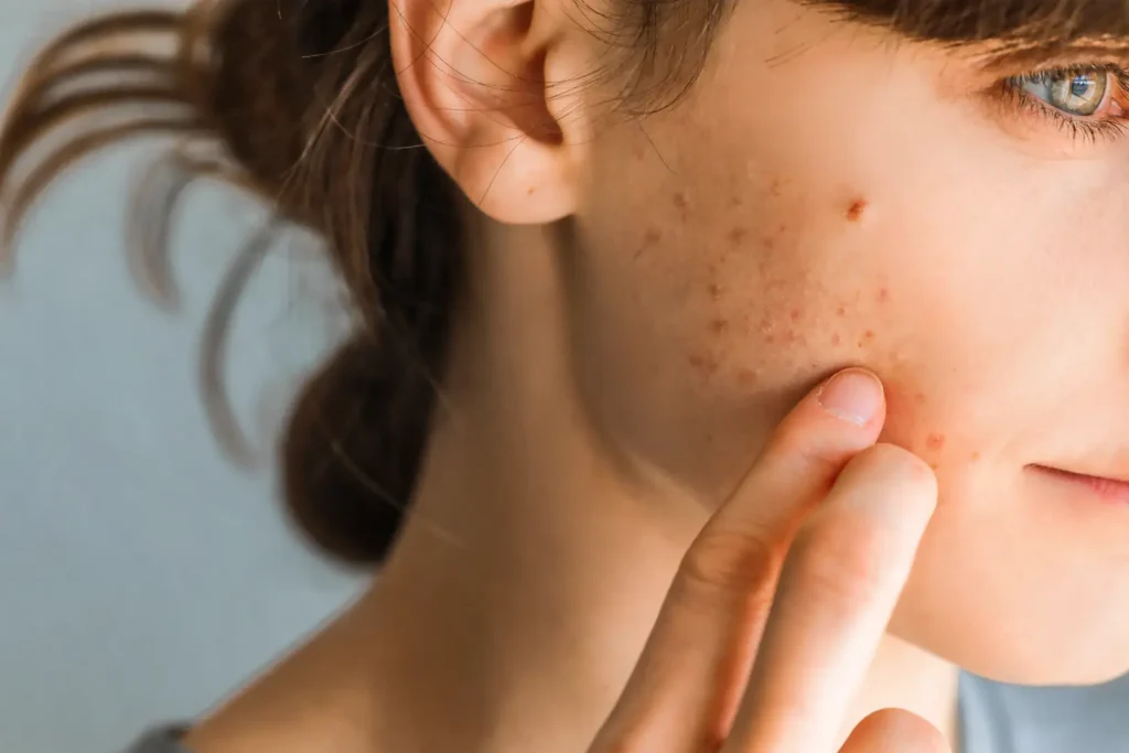 Close-up of a woman touching her cheek where visible blemishes and uneven skin texture are present.
