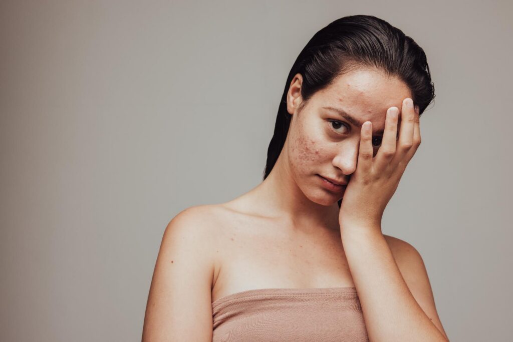 Woman with visible acne marks and uneven texture on her cheeks and forehead rests one hand against her face.